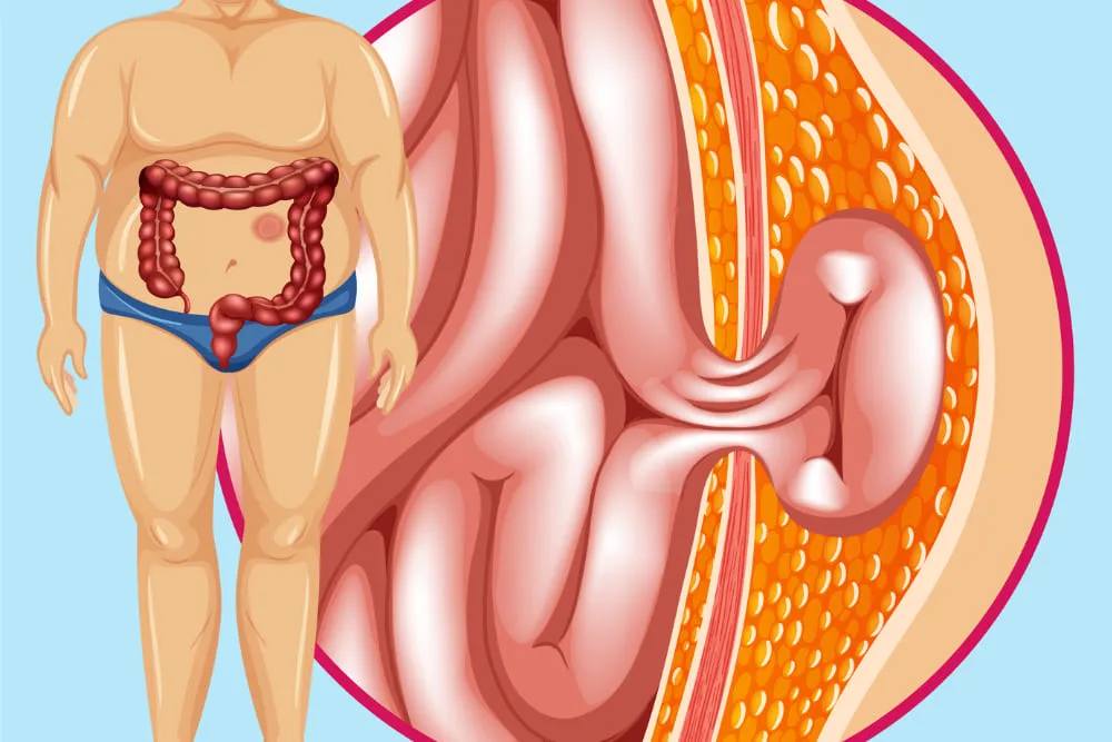 Cirugía de hernia umbilical en Puebla 