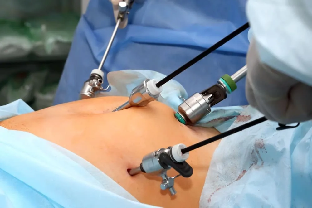 Cirugía para divertículos del colon laparoscópica