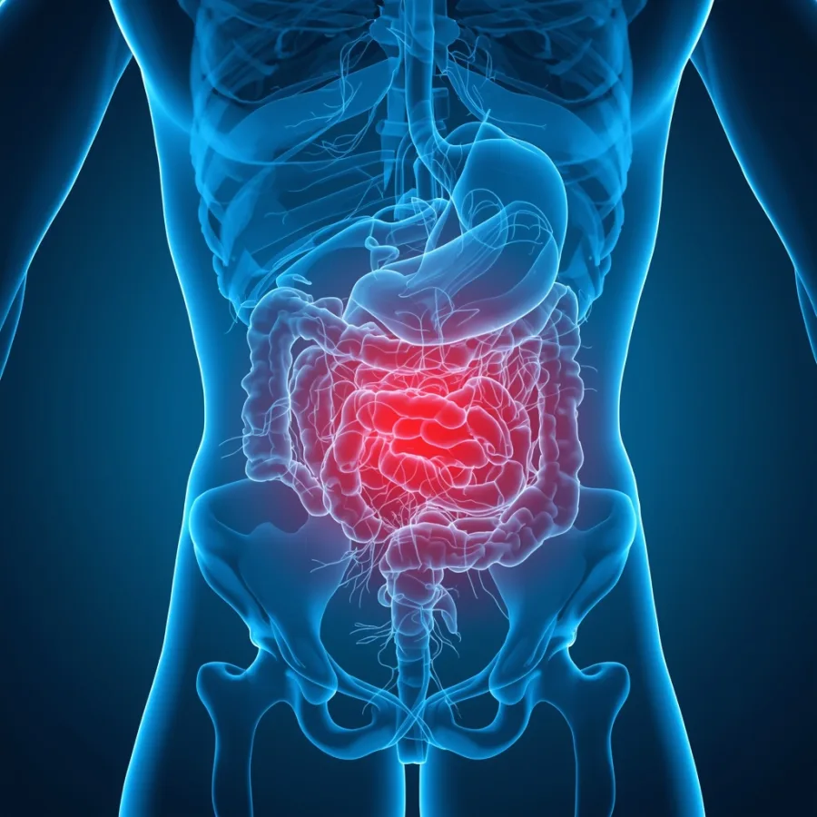 Apendicitis en Puebla